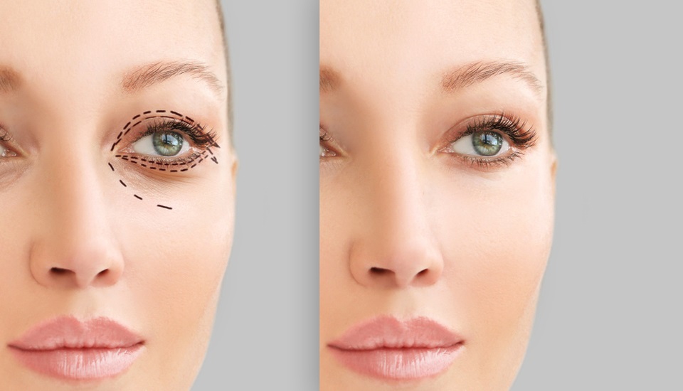 GÖZ KAPAĞI ESTETİĞİ NASIL YAPILIR?